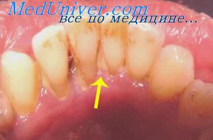 зубная бляшка