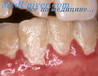 выявление бактерий зубной бляшки