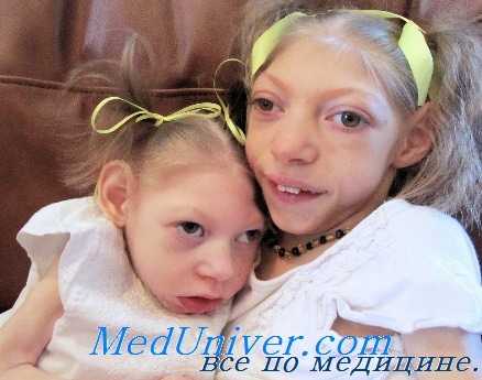 Микроцефалия