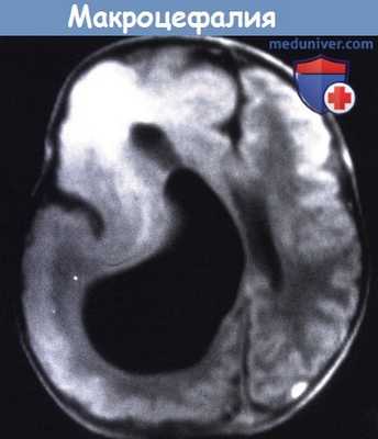 Макроцефалия