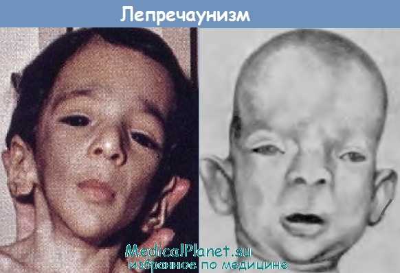 Микроцефалия при лепречаунизме