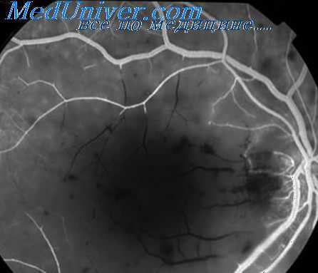 ангиография при алкоголизме