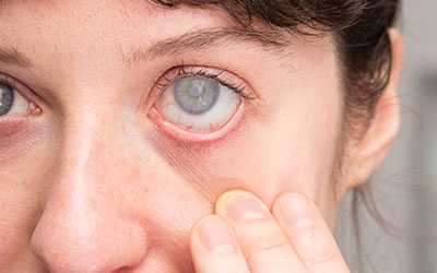 Катаракта - Веримед