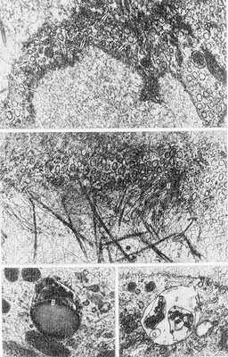 Рис. 6. Электронограмма элементов стенки лимфатических капилляров и окружающей их соединительной ткани: а — эндотелиоцит (стрелками указаны микропиноцитозные везикулы); х 20 000; б — «якорные» филаменты (1), фиксирующие эндотелиоцит (2) к окружающим его коллагеновым протофибриллам (3); х 50 000; в и г — цитоплазма эндотелиоцитов (1 — лизосома, 2 — остаточное тельце); X 60 000.