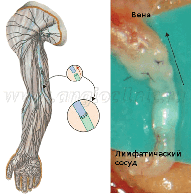 Различные варианты лимфовенозных анастомозов