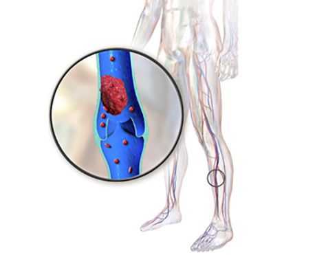 Эмболия периферических артерий