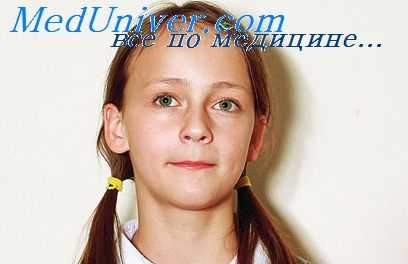 проявления шизофрении