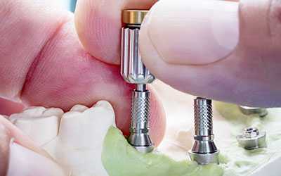 Вспомогательные фиксирующие элементы - Стоматология Линия Улыбки