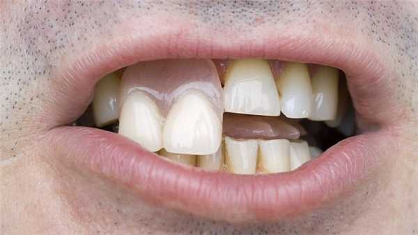 Временные изделия не предусмотрены для постоянного ношения. Их нужно регулярно чистить.