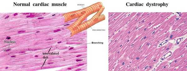 Дистрофия сердечной мышцы