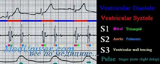 функциональные сердечные шумы