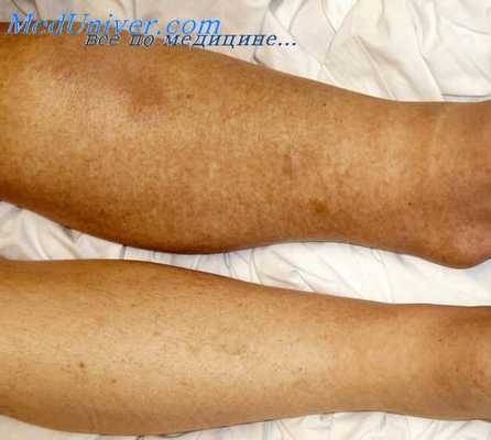 миокардозы