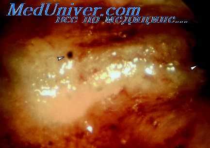 миома матки