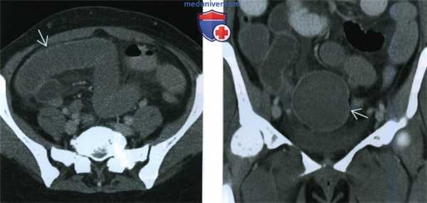 КТ, МРТ, УЗИ при паразитирующей миоме