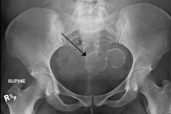 Инструментальная диагностика фибромы матки