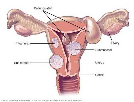 Локализация фиброзных образований матки