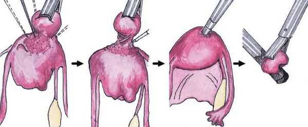 Миомэктомия