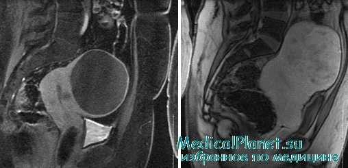 МРТ при миоме матки