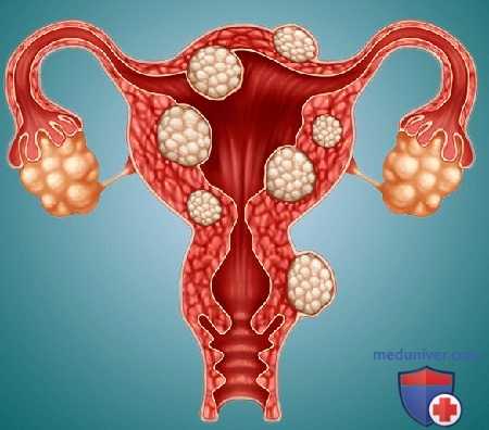 Удалить или лечить миому матки