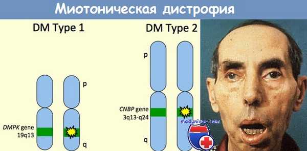 миотоническая дистрофия