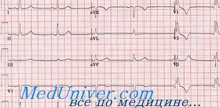 шумы здорового сердца