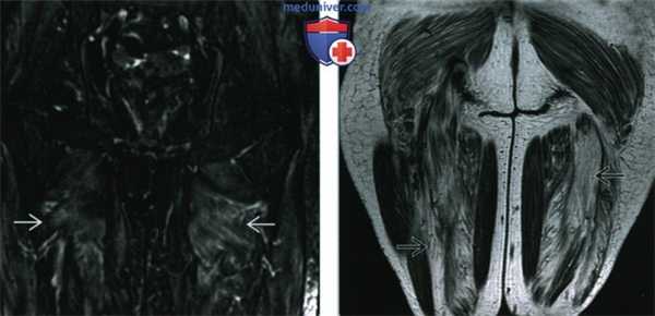 Мышцы при саркоидозе - лучевая диагностика