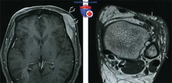 Мягкие ткани при саркоидозе - лучевая диагностика