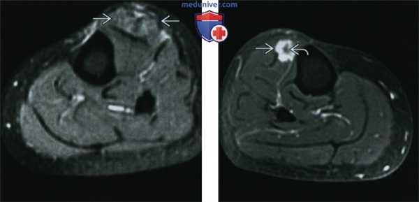 Мышцы при саркоидозе - лучевая диагностика