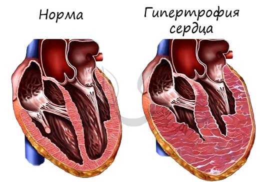 Гипертрофия сердца