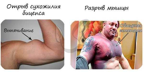 Отрыв сухожилия и разрыв мышцы