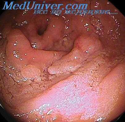 эндоскопия