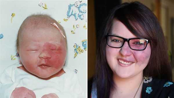 Потемнение винного пятна с возрастом