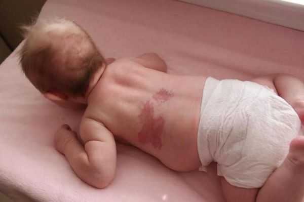 Капиллярная ангиодисплазия