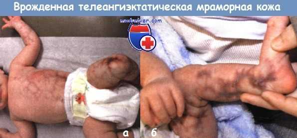 Врожденная телеангиэктатическая мраморная кожа
