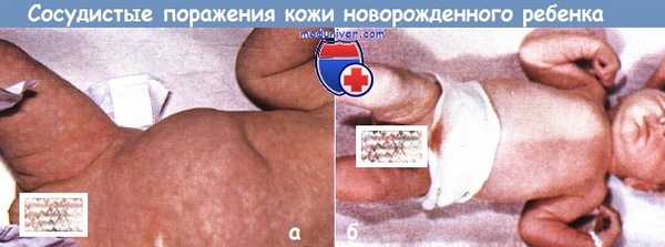 Сосудистые поражения кожи у новорожденных детей