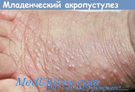 младенческий акропустулез