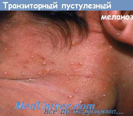 пустулезный меланоз у детей