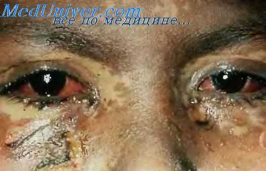 Синдром Стивенса—Джонсона