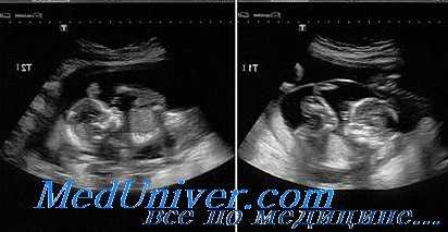 осложнения многоплодной беременности