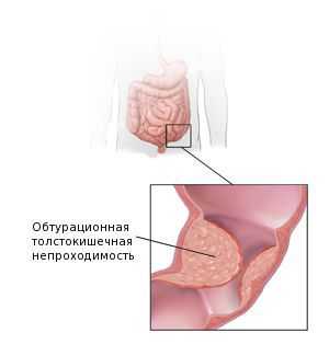 Обтурационная толстокишечная непроходимость