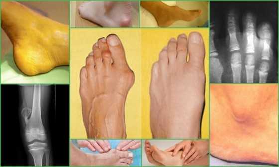 Экзостоз – проявления патологии