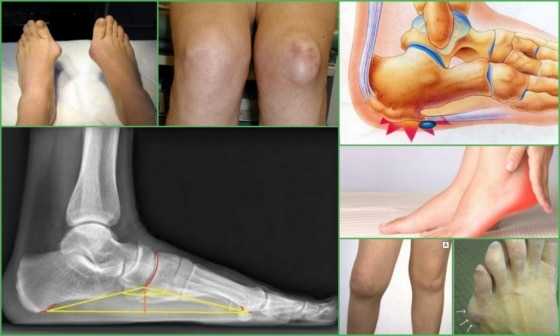 Симптомы экзостоза колена, кости и стопы