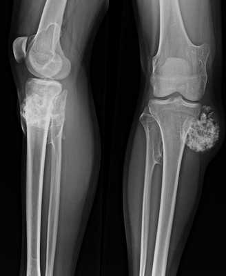 множественная экзостозная хондродисплазия