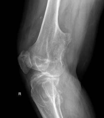 костно-хрящевой экзостоз