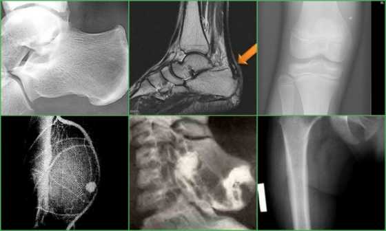 Диагностика экзостоза на ногах
