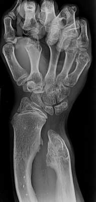 Экзостоз пальцев рук