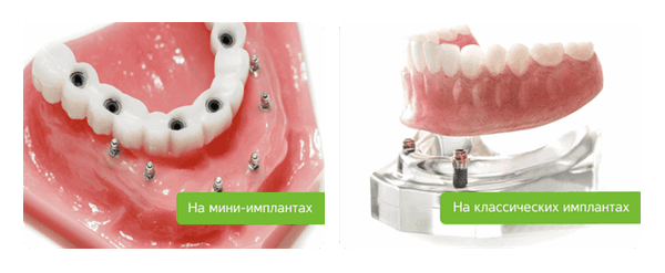 кнопочная фиксация протеза на классических и мини-имплантах