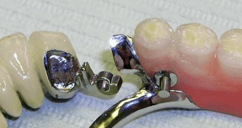 бюгельный протез на аттачменах фото