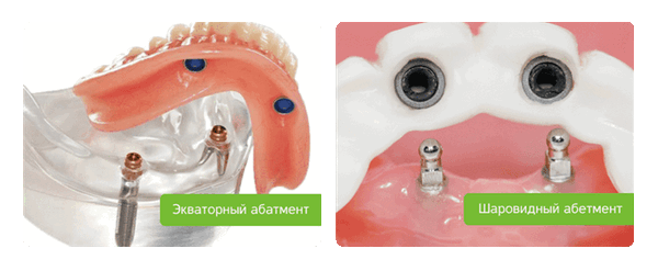 шаровидный и экваторный абатмент съемных протезов