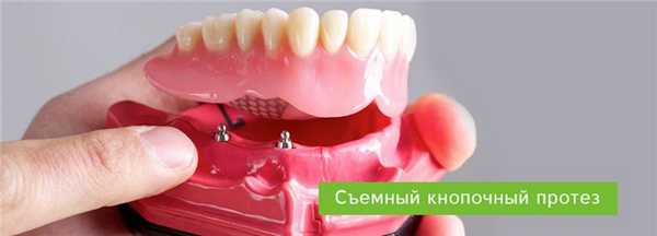 Съемный протез на имплантах с кнопочной фиксацией